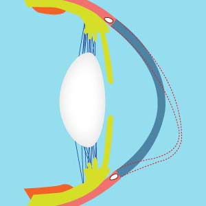 Crosslinking bei Keratokonus