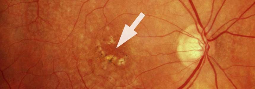 Trockene altersbedingte Makuladegeneration