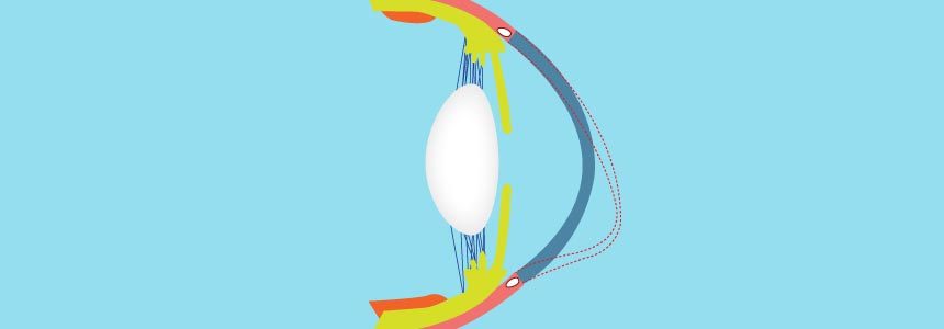 Crosslinking bei Keratokonus