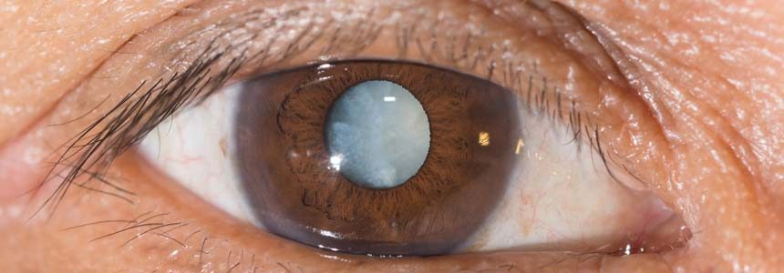 Grauer Star Katarakt