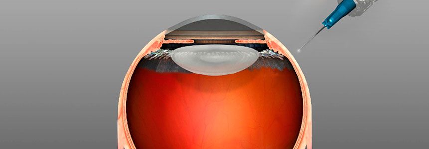 Intravitreale operative Injektion (IVOM)