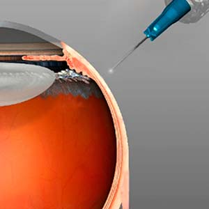 Intravitreale operative Injektion (IVOM)